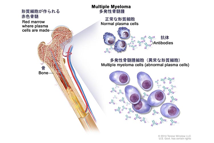 形質細胞腫瘍（多発性骨髄腫を含む）の治療のイメージイラスト